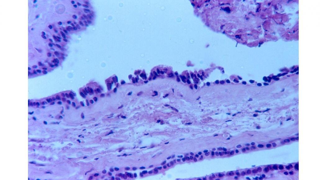 Cisto Do Ducto Nasopalatino Patologia Bucal