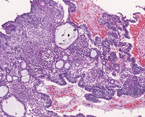 Imagem microscópica do ameloblastoma adenoide