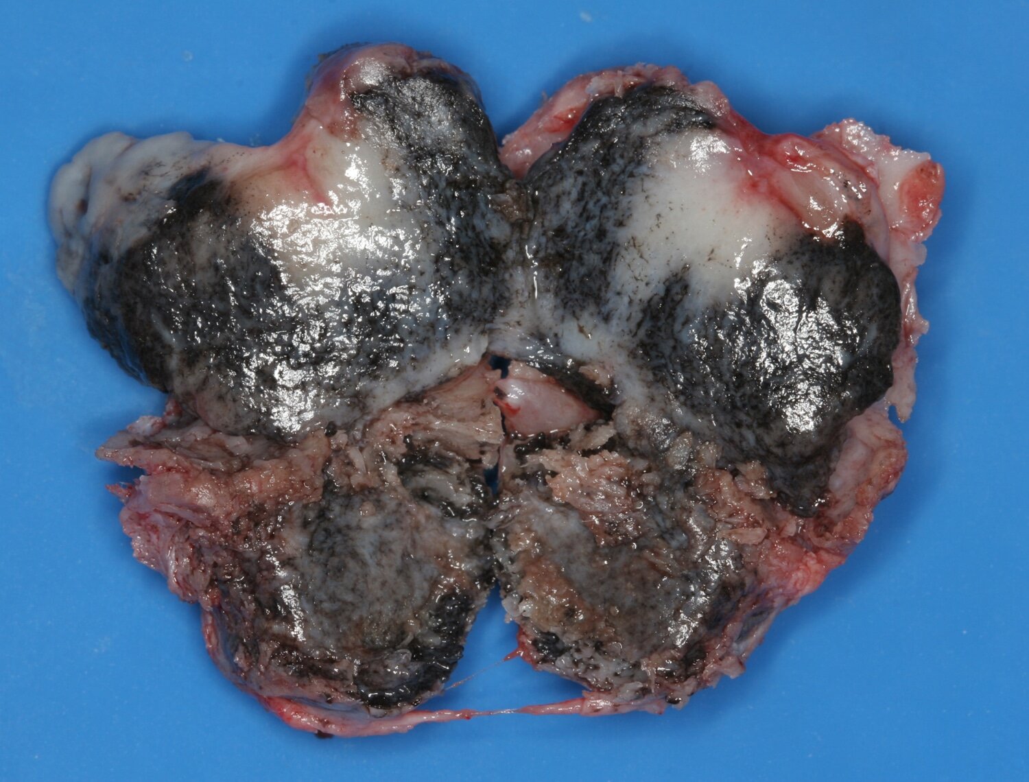 Tumor Melanótico Neuroectodérmico da Infância - Patologia Bucal