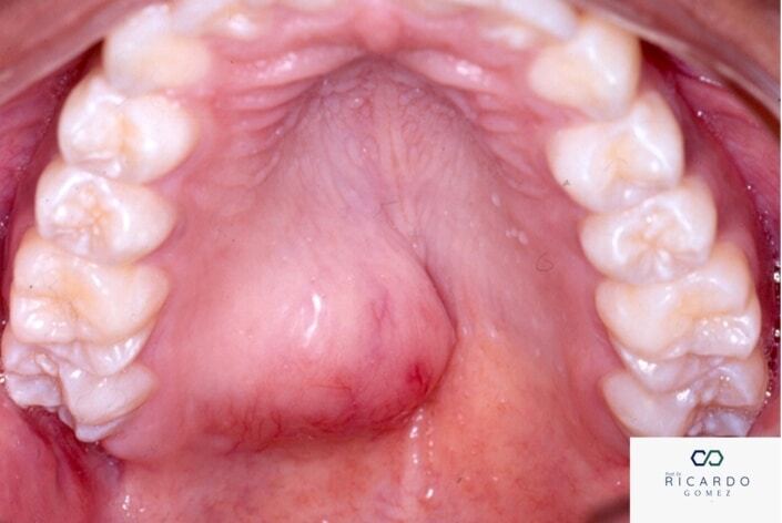 Adenoma Pleomórfico - Patologia Bucal