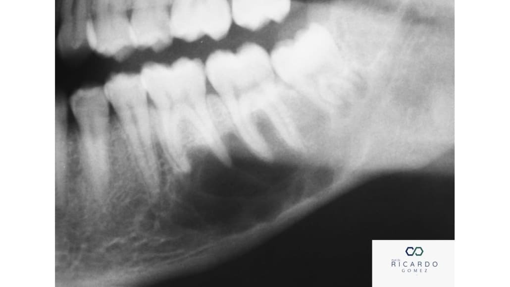 Imagem radiográfica da cavidade óssea idiopática