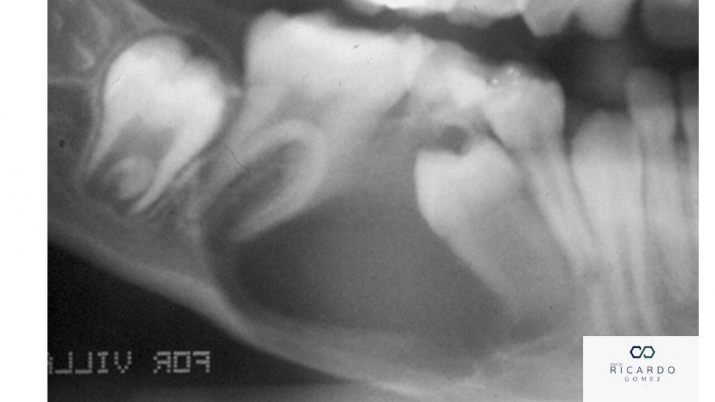 Imagem radiográfica do cisto dentígero