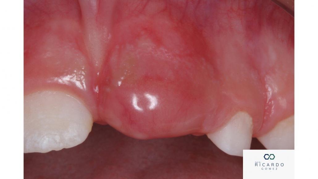 Imagem clínica do cisto de erupção
