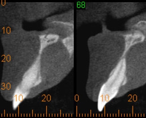 Imagem tomográfica do cisto do ducto nasopalatino