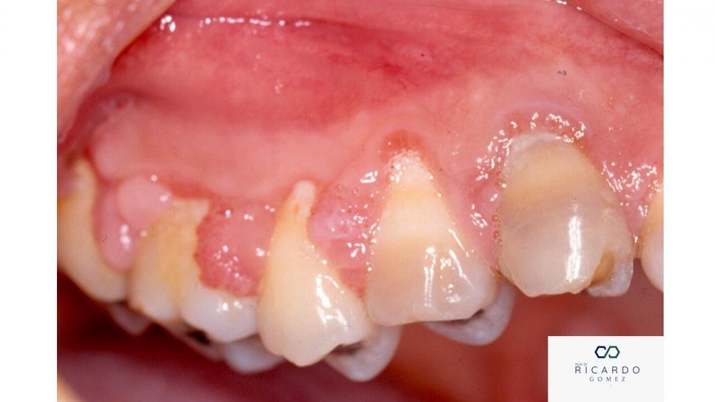 Imagem clínica do condiloma acuminado na mucosa oral.