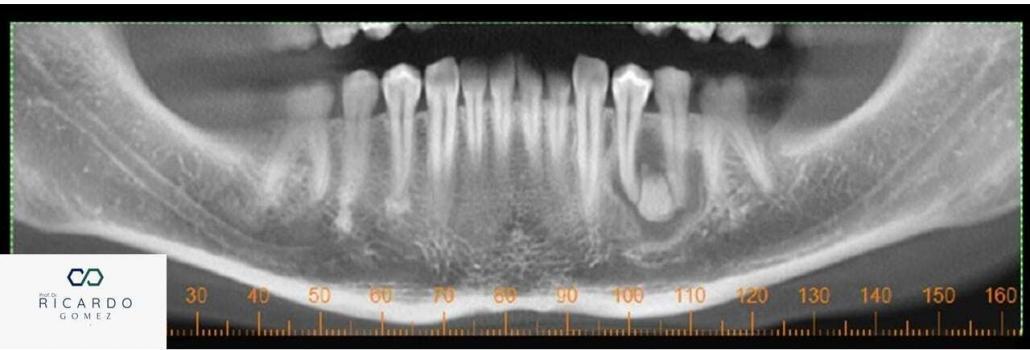 Imagem radiográfica da displasia cemento-óssea focal na mandíbula