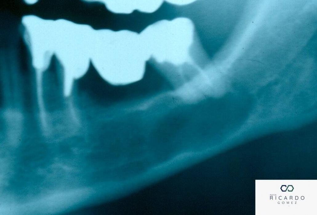 Imagem radiográfica do defeito osteoporótico focal da medula óssea.