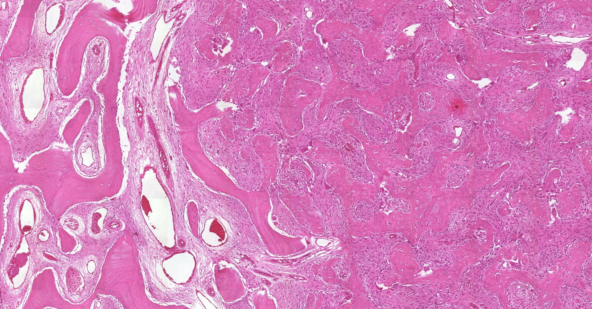 Displasia Fibrosa - Patologia Bucal