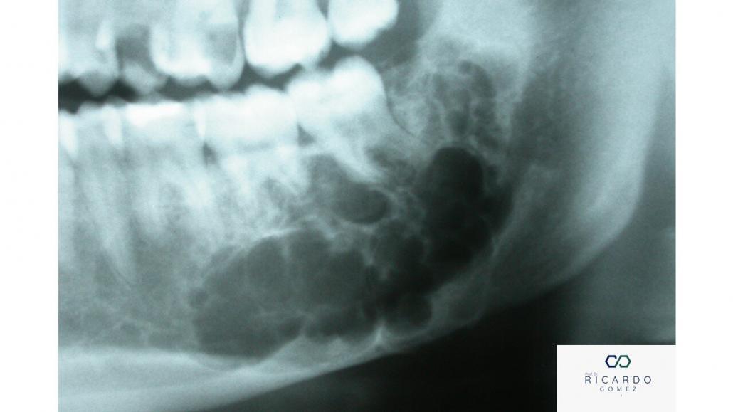 Imagem radiográfica do fibroma ameloblástico