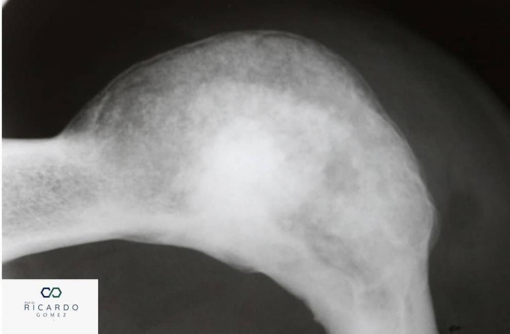 Imagem radiográfica do fibroma cemento-ossificante em mandíbula.