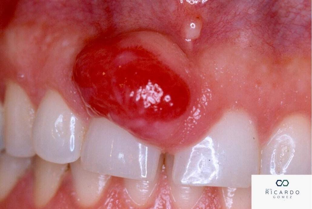 Imagem clínica do fibroma ossificante periférico