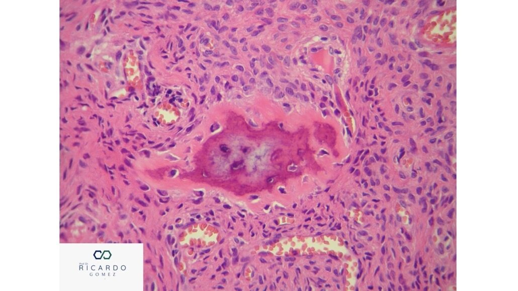 Fibroma Ossificante Periférico - Patologia Bucal