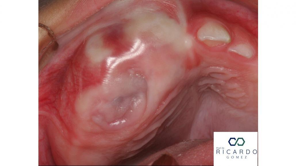 Imagem clínica do tumor melanótico neuroectoderma da infância