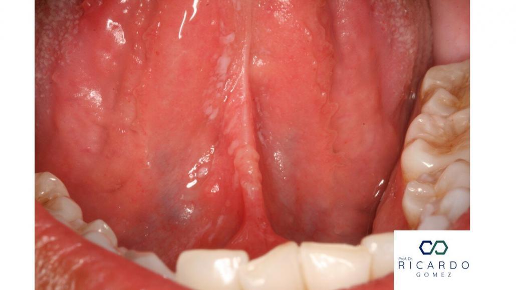 Imagem clínica da candidíase oral