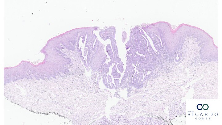 Imagem microscópica do sialoadenoma papilífero