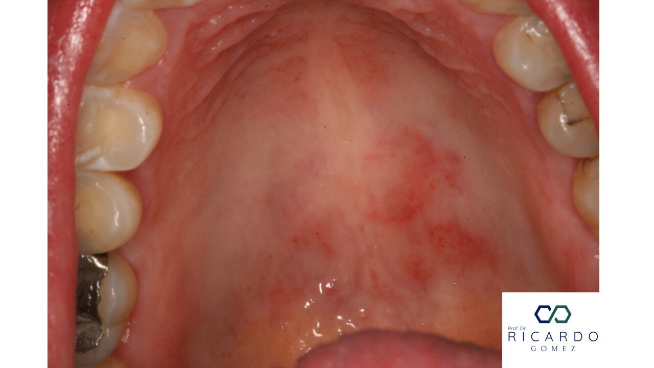 Candidíase - Patologia Bucal