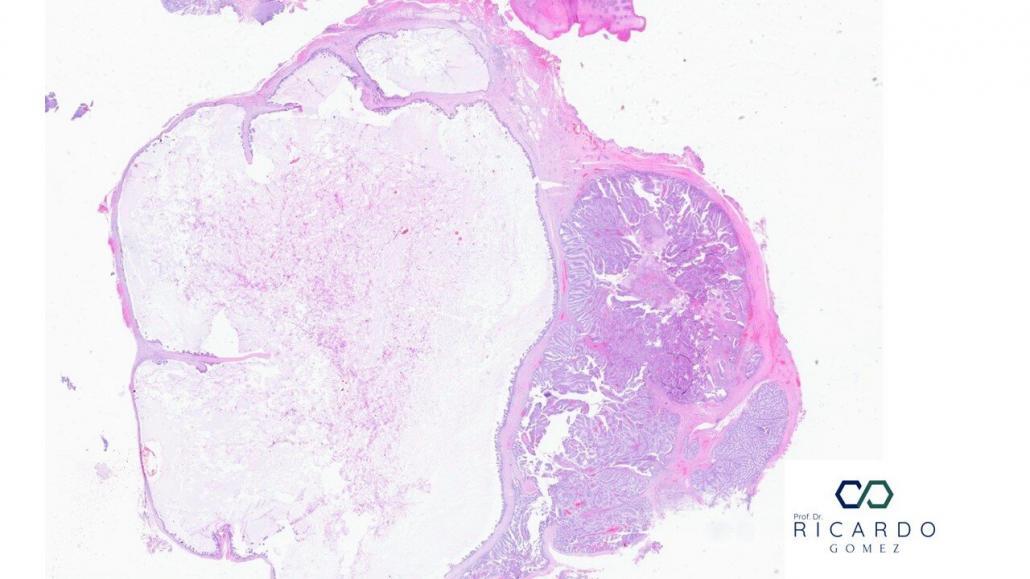 Imagem microscópica da neoplasia mucinosa papilar intraductal