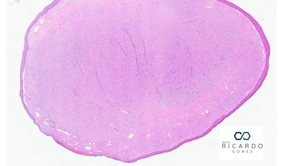 Imagem microscópica da epúlide congênita de células granulares
