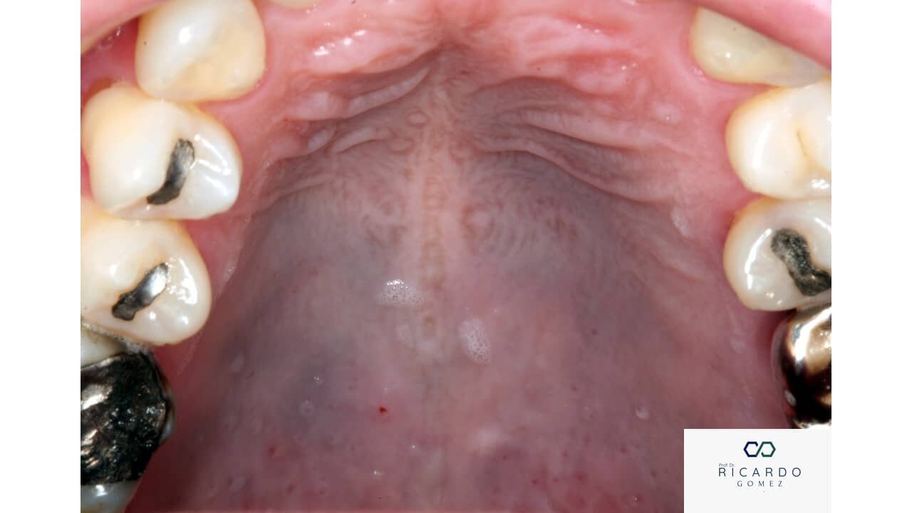 Desafios no diagnstico das leses pigmentadas da mucosa bucal - Patologia Bucal Desafios no diagnstico das leses pigmentadas da mucosa bucal - Patologia Bucal