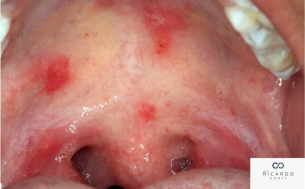 Resumo de herpangina: fisiopatologia, diagnóstico e tratamento