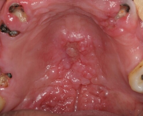 leishmaniose oral