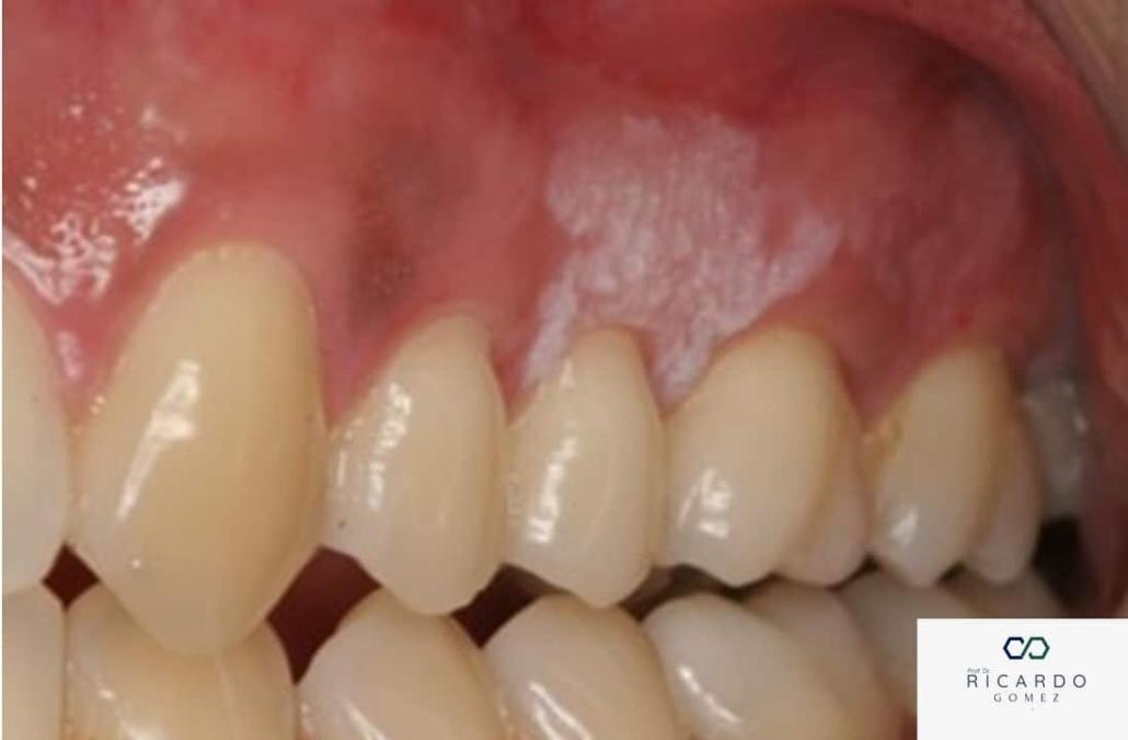 Leucoplasia - Patologia Bucal