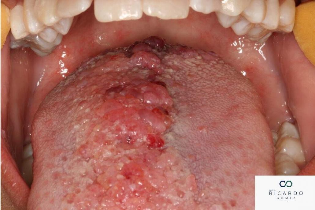 Imagem clínica do linfangioma oral