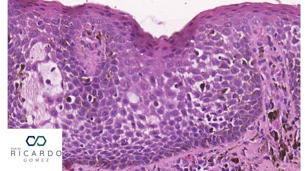 Imagem microscópica do melanoacantoma