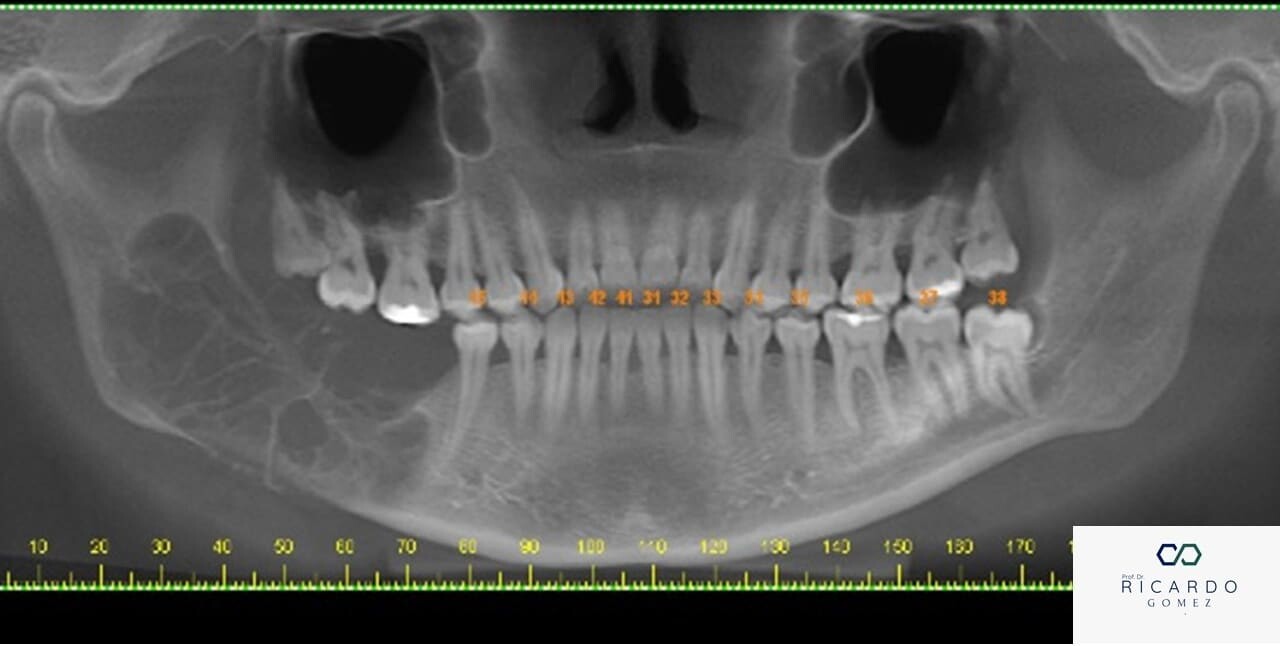 Aspecto radiográfico do mixoma odontogênico