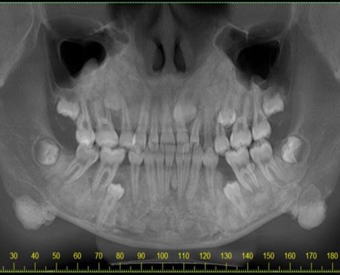 Imagem tomográfica de um paciente com a síndrome de Gardner