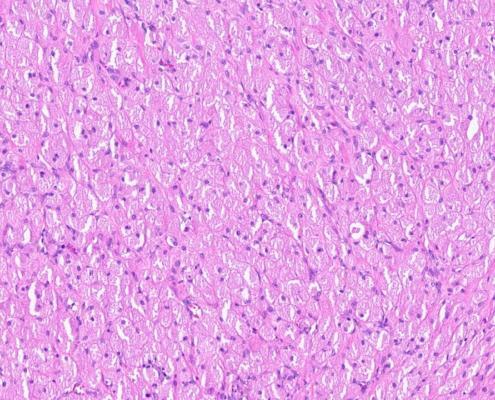 Imagem microscópica da epúlide congênita do recém-nascido