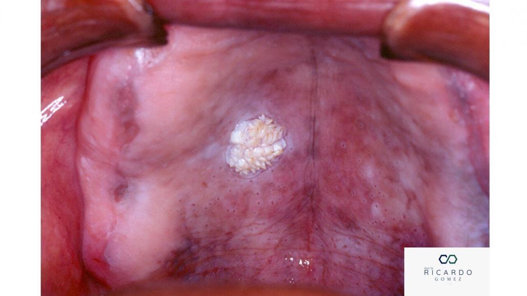 Imagem clínica do papiloma escamoso