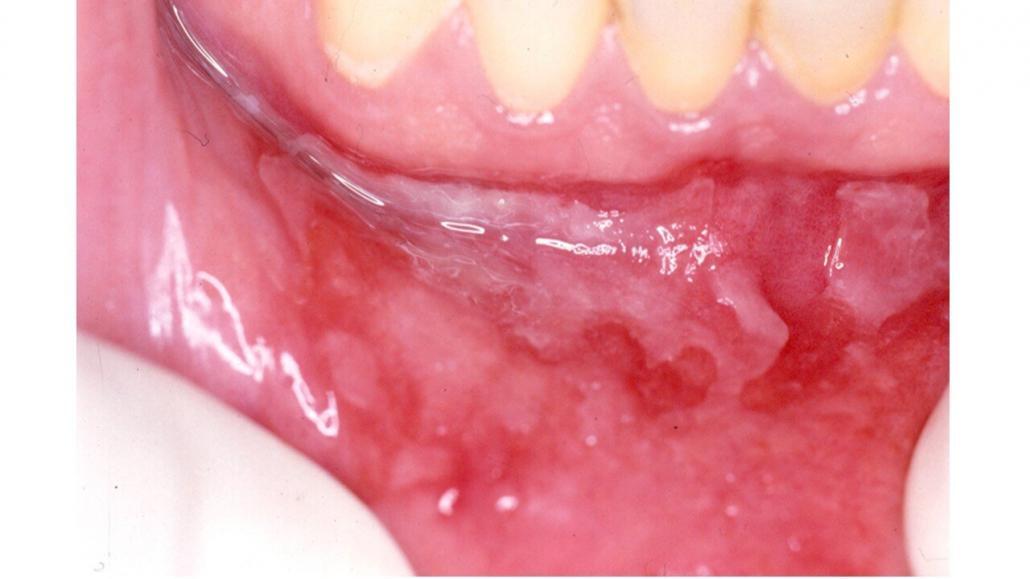 Penfigoide das Membranas Mucosas - Patologia Bucal