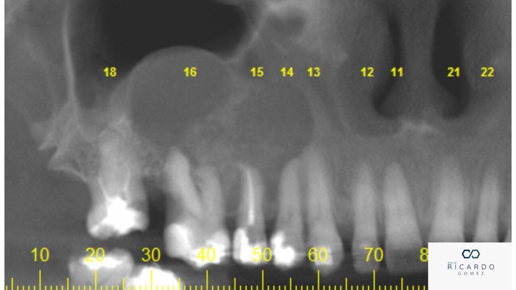 Imagem tomográfica do fibroma ossificante juvenil psamomatoide.