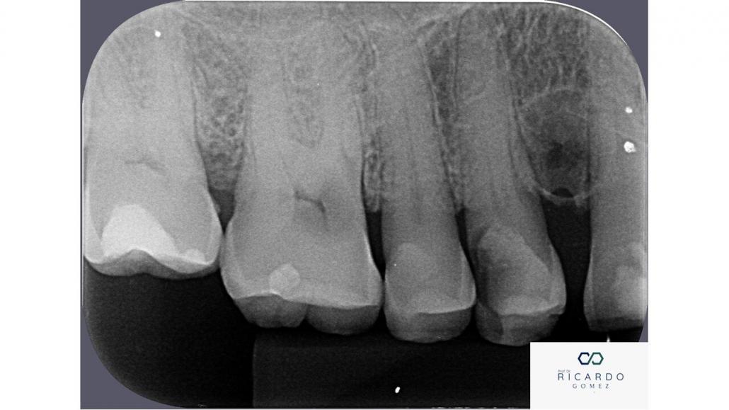 Imagem radiográfica do cisto periodontal lateral