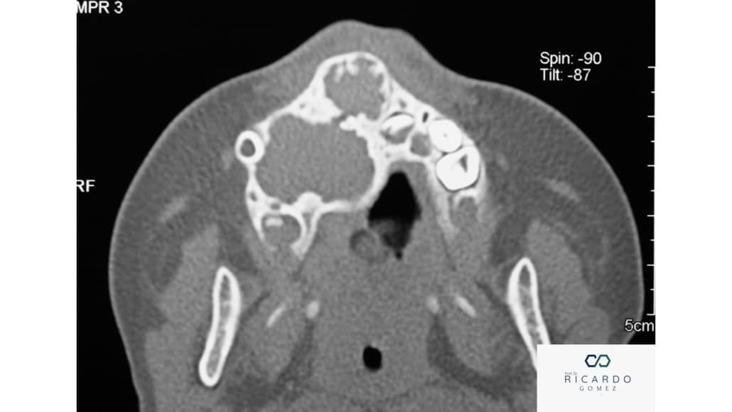 Tumor Melanótico Neuroectodérmico da Infância - Patologia Bucal