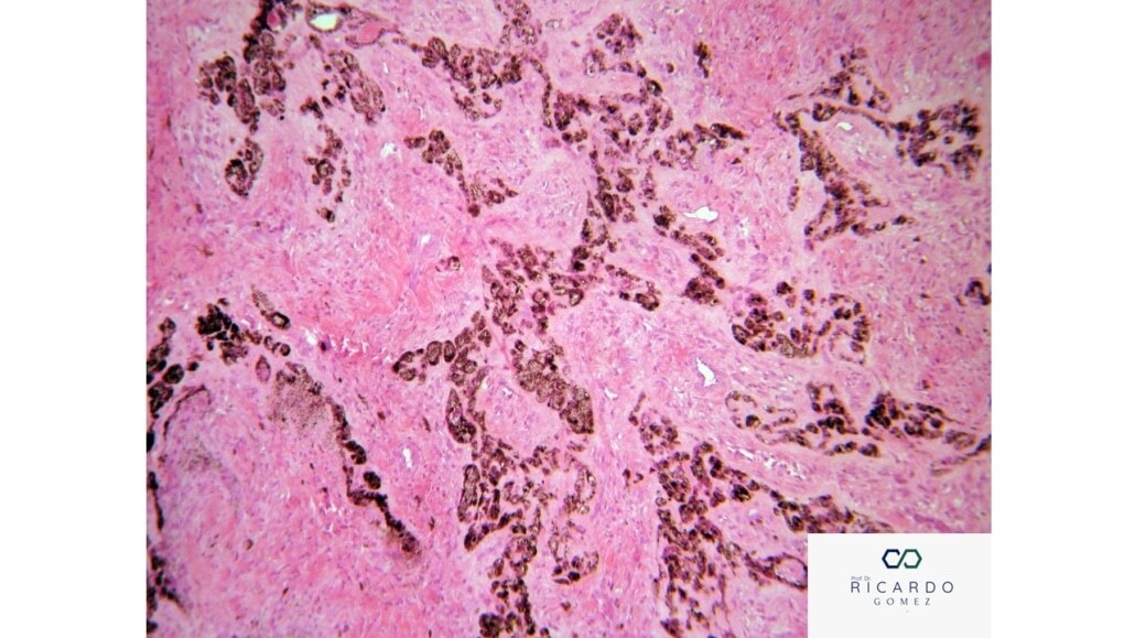 Tumor Melanótico Neuroectodérmico da Infância - Patologia Bucal