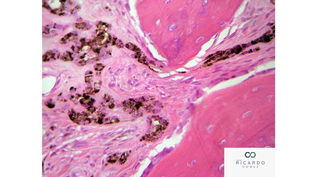 Tumor Tumor Melanótico Neuroectodérmico da Infância - Patologia Bucal