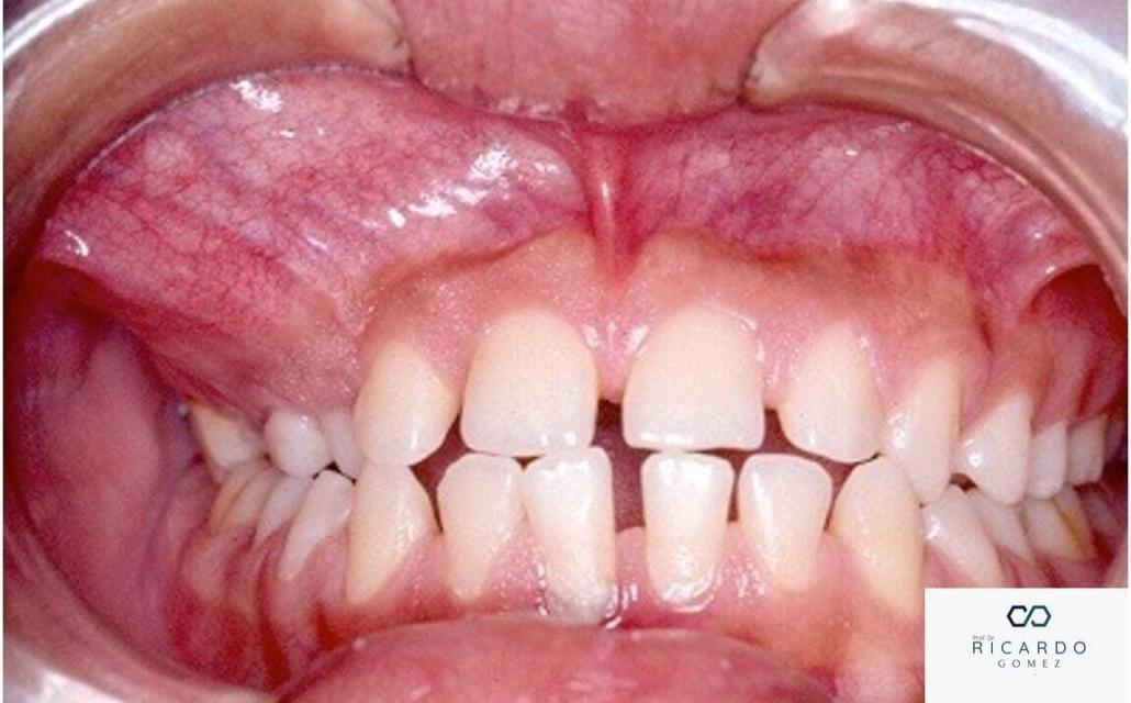 Aspecto clínico do tumor odontogênico adenomatoide