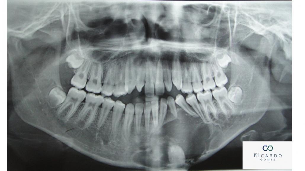 Tumor Odontogênico Epitelial Calcificante - Patologia Bucal