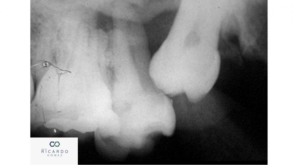 Tumor odontogênico escamoso