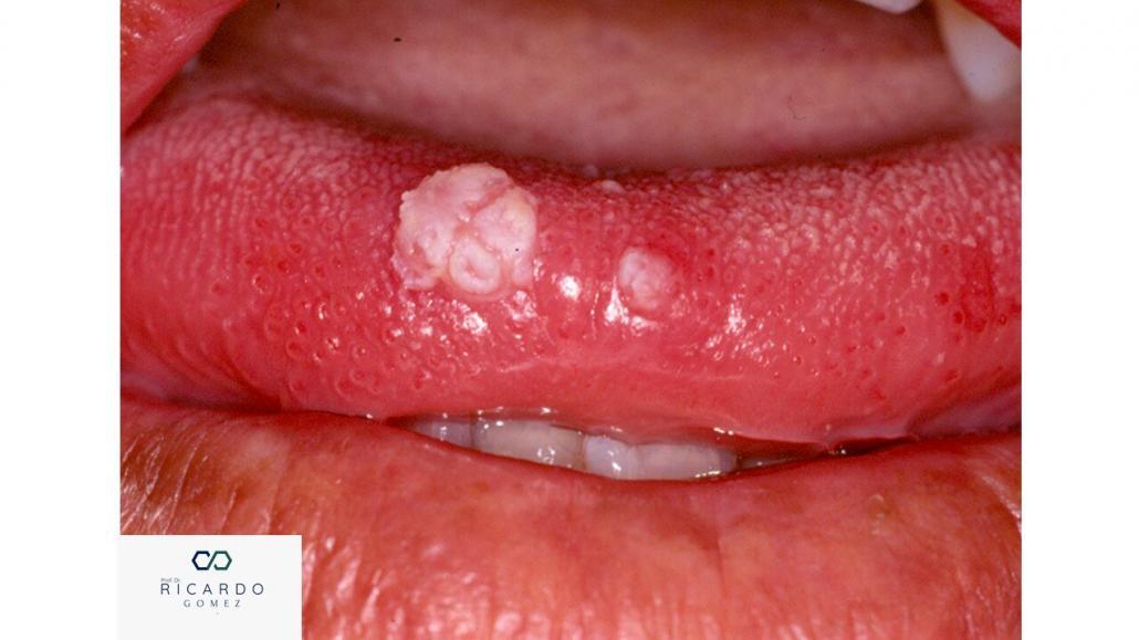 Imagem clínica da verruga vulgar na mucosa oral.