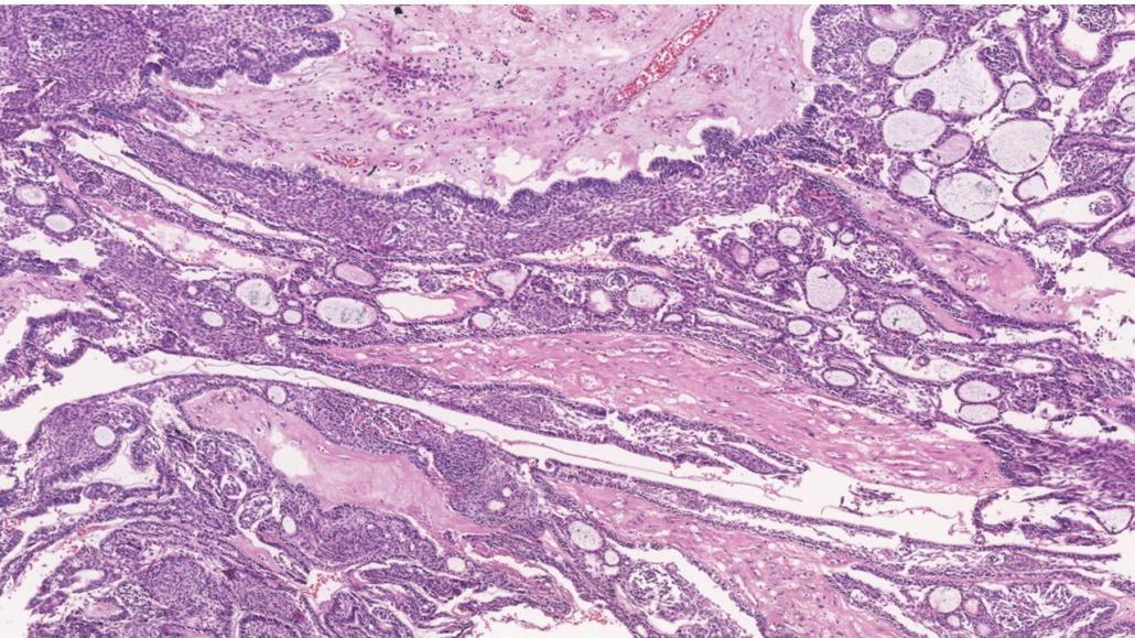 Imagem microscópica do ameloblastoma adenoide