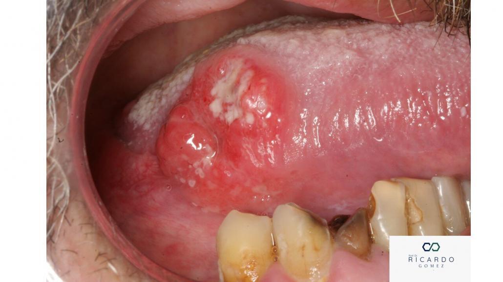 Imagem clínica do carcinoma de células escamosas de boca