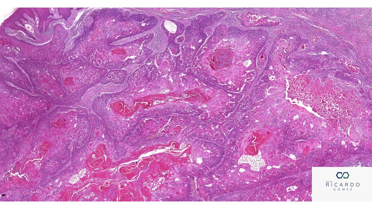 Carcinoma De Células Escamosas Patologia Bucal