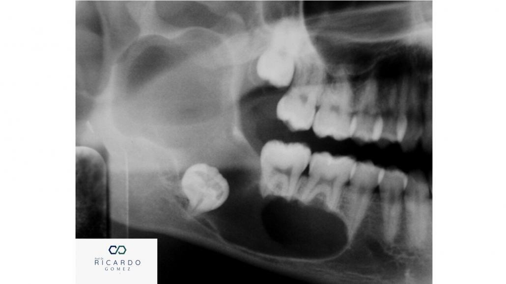 Aspecto radiográfico do ceratocisto odontogênico