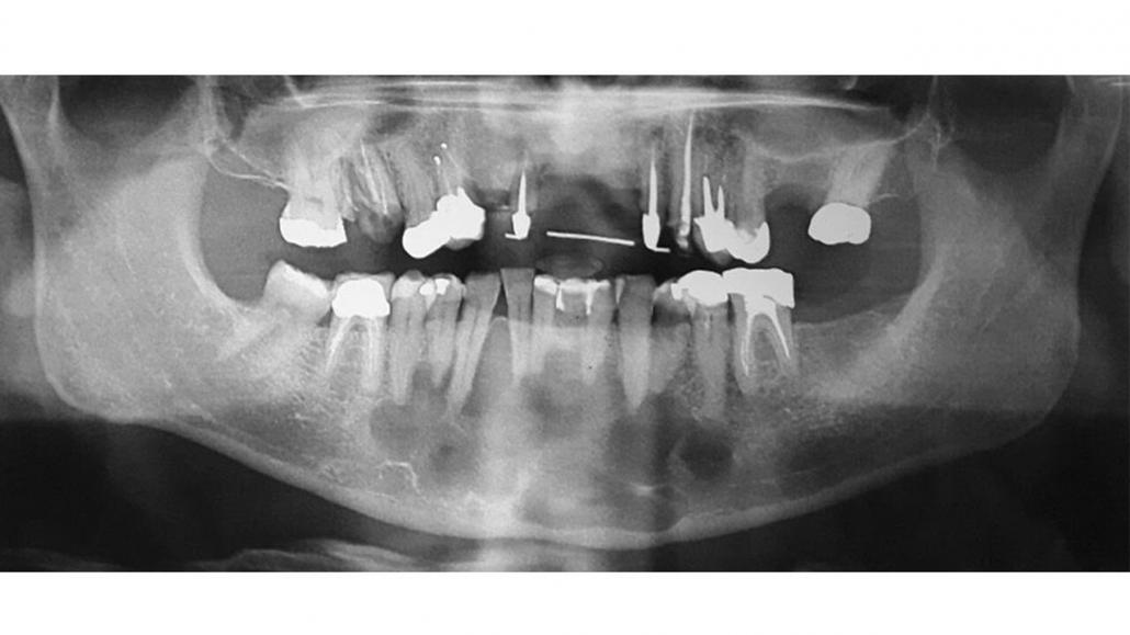 Imagem radiográfica do cisto odontogênico glandular