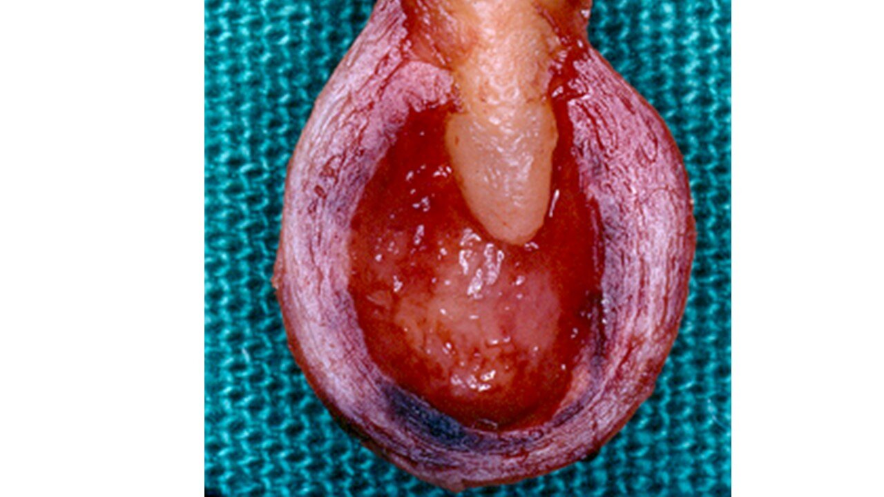 Cisto de Erupção Patologia Bucal