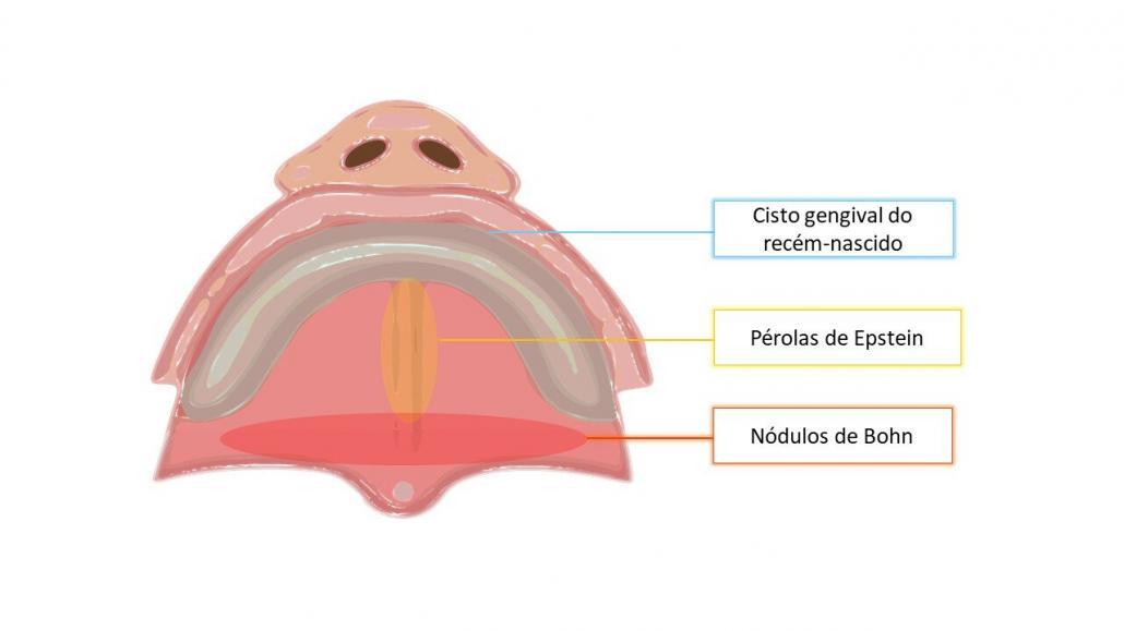 Ilustração esquemática mostrando a localização do cisto gengival do recém-nascido, das Pérola de Epstein e dos nódulos de Bohn.