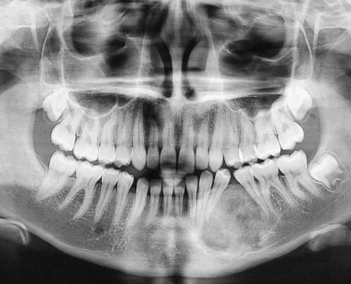 Fibroma ossificante juvenil trabecular